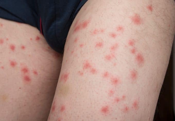 This is what a Bed Bugs Bites looks like
