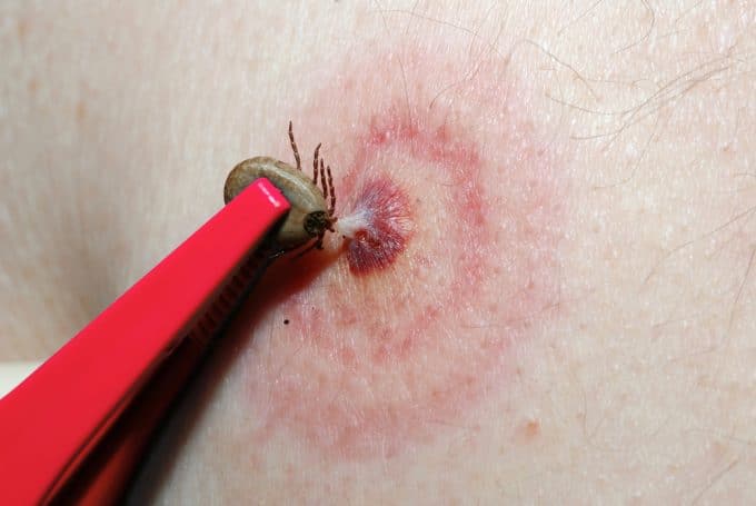 This is what a Tick Bite looks like