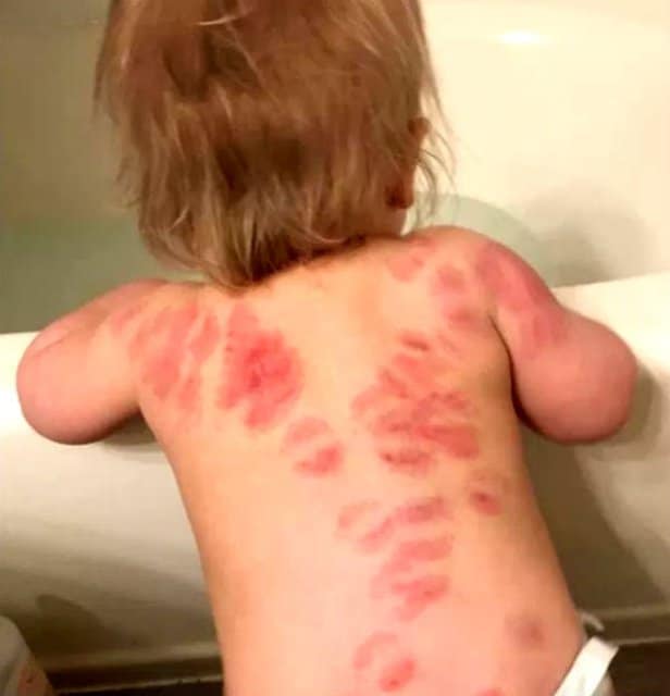 Mom Says Daughter Bitten At Daycare 25 times 