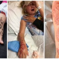 Little Girl Suffered Severe Chemical Burns Caused By a Temporary Tattoo